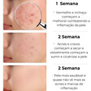 Secativo de Espinhas em Gel - Fórmula Asiática com Ácido Salicílico