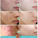 Secativo de Espinhas em Gel - Fórmula Asiática com Ácido Salicílico